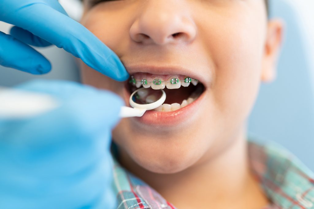 Orthodontics is a branch of dentistry that focuses on the diagnosis, prevention, and treatment of a patient's jaw, face, and bite irregularities.
