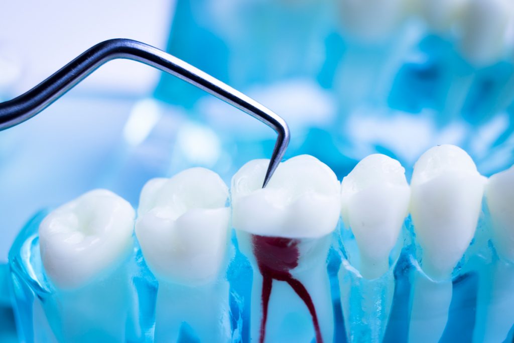 Root canal therapy is treatment used to repair and save a tooth that has been infected due to a deep cavity or cracked tooth.