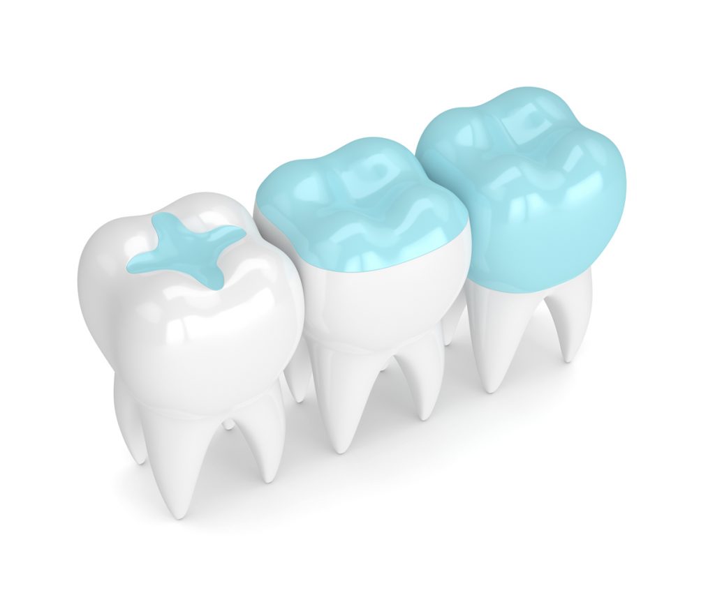 Dental inlays and onlays are a more conservative approach to tooth restoration than full crowns.