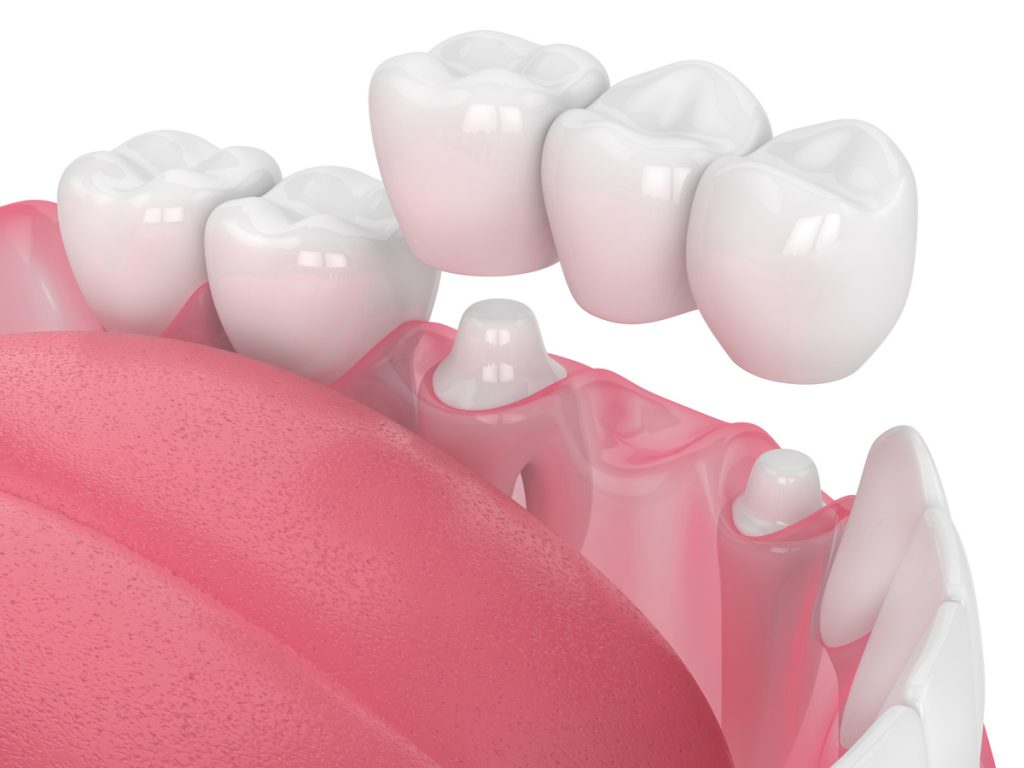 A dental bridge is a false tooth that is used to fill the gap created by a missing tooth or teeth.