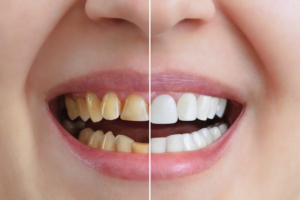 Our teeth can discolor through the years as our enamel wears down. The wearing down of enamel allows dentin, a yellow color substance that makes the core of our teeth, to show through.